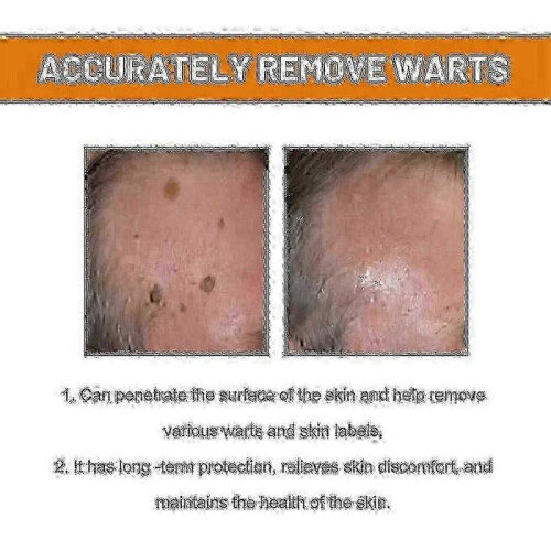 (1pc)Bee Venom For Warts And Papillomas 2