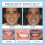 (2pcs) Silicone Dentures Reline Set, Silicone Relining Dentures Set, Dentures Silicone Relining Kit, Dentures Set, Dentures Relining Kit 4
