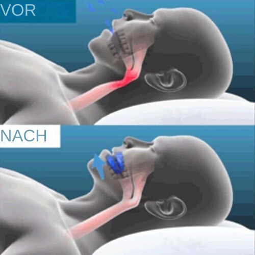 Anti-Snoring Device Adjustable Mouthpiece for Snoring Reduction, Night Guard for Teeth Grinding, Comfortable Bite Splint 2