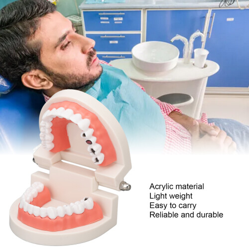 Teeth Caries Educational Model Resin Dental Disease Training Tool for Students 2