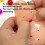 Elastic Acne Popping Toy, Squeezing Fun, TPE, For Ages 6+ 8