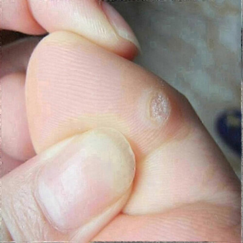 144pcs Plasters for Removal Of Fibromas 2