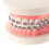 Dental Teeth Malocclusion Orthodontic Model With Full Metal Brackets Hoops Dentist Teaching 6
