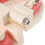 Dental Teeth Malocclusion Orthodontic Model With Full Metal Brackets Hoops Dentist Teaching 7