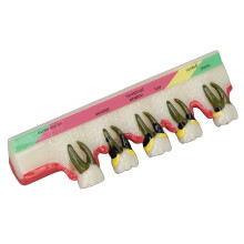 Modelo dental patológico de cerámica, translúcido