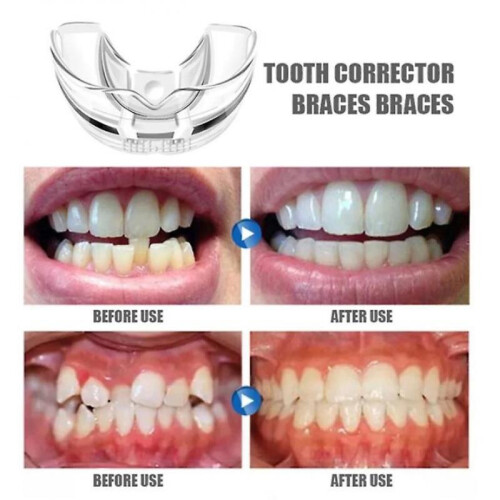 3pcs/set Dental Tooth Orthodontic Appliance Trainer for Alignment Braces 1