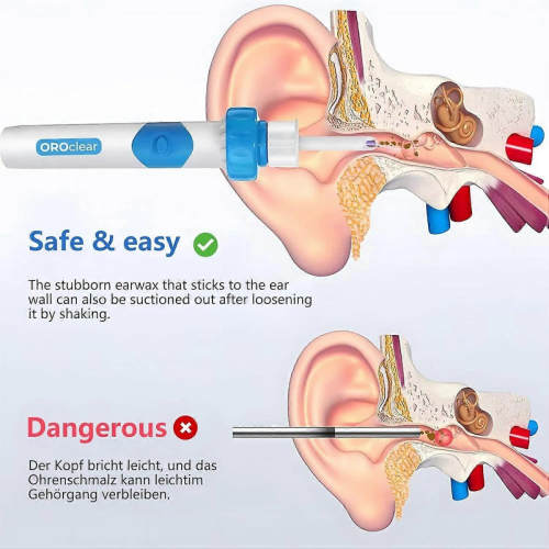 Oroclear Earwax Remover, Electric Ear Cleaner, Oroclear Ear Wax suction remover 1