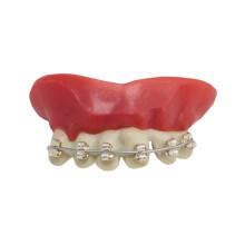 Denture braces