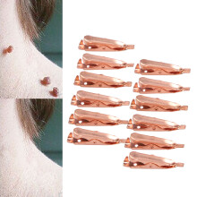 Clips en cuivre pour l'élimination des acrochordons, 12 pièces, 2,7 cm