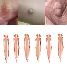 Clips en cuivre pour l'élimination des acrochordons 6 pièces 2,7 cm (1,06 po)