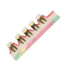 Dental Periodontal Disease Study Model Tooth Teaching Tool Resin Dental School