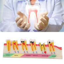 Modèle portable de caries dentaires - dents en résine