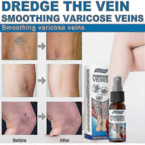2-4X Varicose Vein Massage Spray for South Moon 2