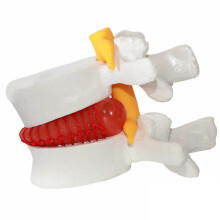 Lumbar Disc Prolapse Model Life Size Portable Anatomical Human Spine Model for Medical Education and Scientific Presentations