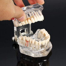 Sick Teeth Dental Implant Model for Medical Science Teaching with Restoration Bridge Tooth for Dentist Training