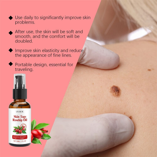 Ouhoe Rosehip Seed Wart Removal Essential Oil 30ml 2