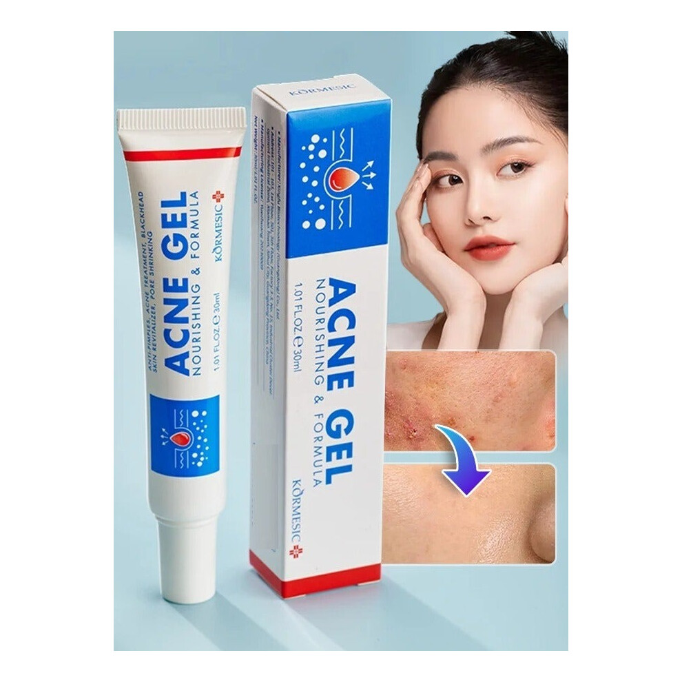Cream Kormesic Acne Gel 30Ml | Pimple For Acne Prone Skin Care For All Skin Types