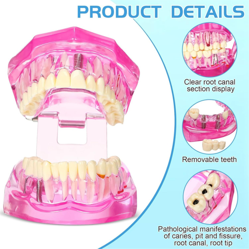 Modelo de dentes com doença, tipodontes dentários, modelo de dentes com implante (rosa, 2 peças) 2