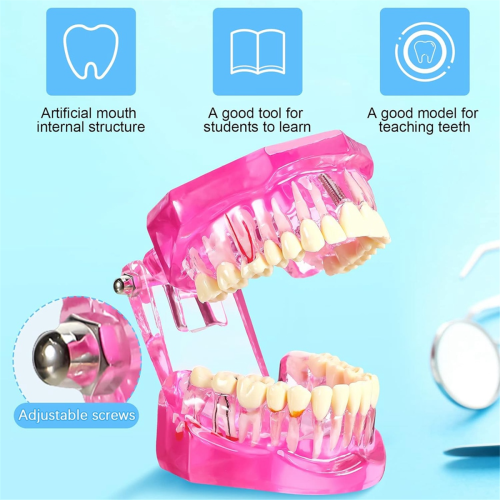 Modelo de dentes com doença, tipodontes dentários, modelo de dentes com implante (rosa, 2 peças) 1