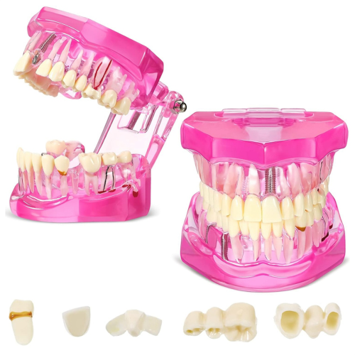 Modelo de dentes com doença, tipodontes dentários, modelo de dentes com implante (rosa, 2 peças)