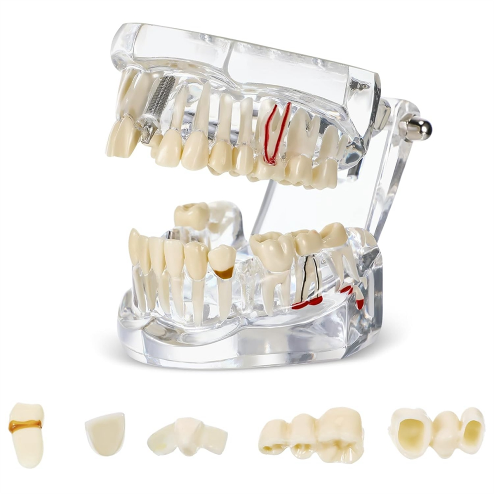 Disease Teeth Model Dental Typodonts Implant With Removable Dentist Standard Tooth Demonstration 4852514344073