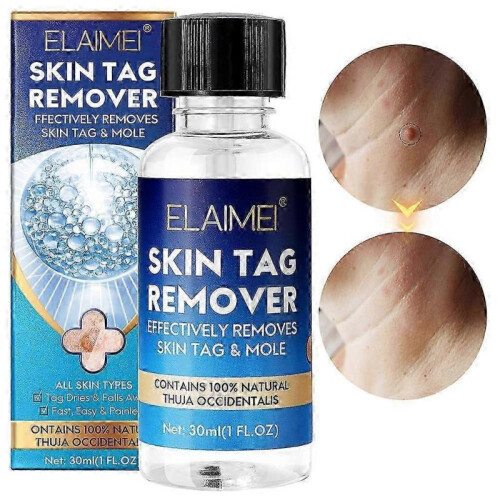 (1pcs) Skin tag remover liquid for wart and mole treatment 1