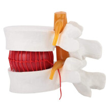 1:1.5 Human Anatomical Model for Lumbar Disc Herniation Demonstration - Detailed Anatomy Model, Educational Tool, Anatomical Study