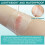 Hydrocolloid Roll for Wound Care, Hydrocolloid Patch Bandages Self-... 7