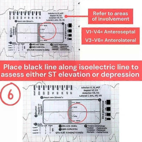 3Pc ECG 7 Step Ruler ECG 7 Step Ruler For ECG/EKG Interpretation ECG Reference Guide Ruler EKG Calipers 2