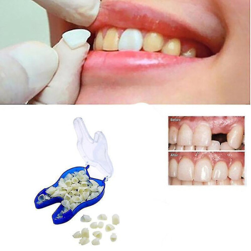 Temporary Tooth Repair Kit Teeth And Gaps Teeth Teeth Whitening Tooth Back Teeth
