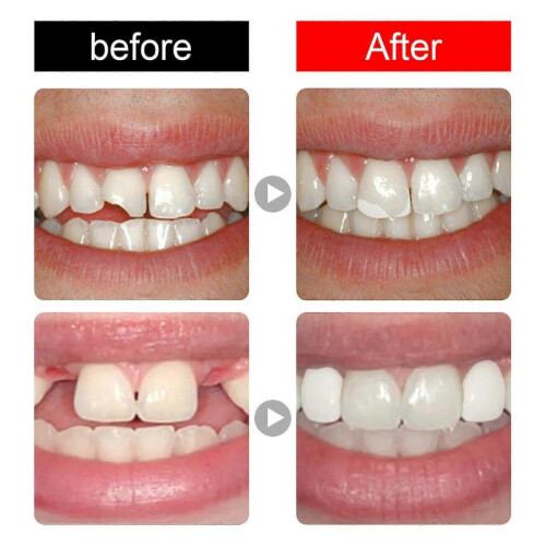 Moldable Tooth Filling False Teeth Temporary Repair Kit Solid Glue Denture for Missing Broken 2