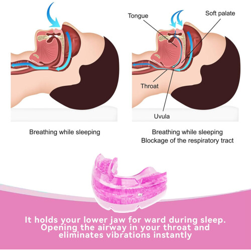 Adjustable Anti Snoring Device Mouth Guard for Teeth Grinding, Includes Storage Case, Custom Fit, Comfortable Design 2