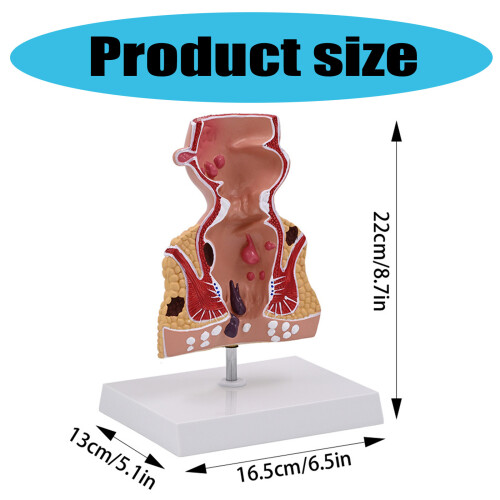 Human Rectum Model Pathologies of Rectum Model School Teaching 2
