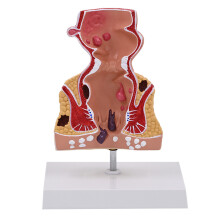Human Rectum Model Pathologies of Rectum Model School Teaching