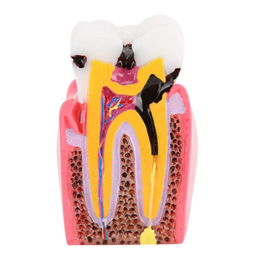 Anatomisches Zahnmodell - Karies-Studie für Zahnärzte 1