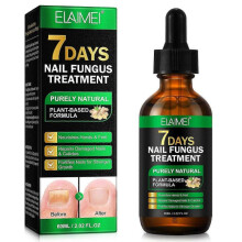 Nail Fungus Treatment, Ginger Nail Fungus Treatment, Toenail Cuticle Care Oil Care, Fungal Nail Treatment, 7 Days Nail Fungus Treatment for Toenail
