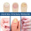 Patchs Traitants pour Mycoses et Ongles Incarnés des Orteils - Soin Complet 3