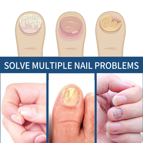 Patchs Traitants pour Mycoses et Ongles Incarnés des Orteils - Soin Complet 2