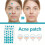 Patchs Hydrocolloides Invisibles pour Boutons - Absorbants et Cicatrisants 3
