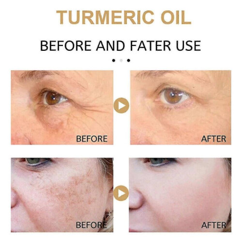 Turmeric Cream Corrector Skin Melasma Remove Serum Anti-spot 1