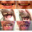 MULTI-SHADE INSTANT Temporary SMILE TEMPORARY REPLACEMENT TEETH KIT 5