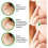 72pcs Skin Tag Remover Warts Remover Patch Face Corn Plaster Acne Warts Treatment 5