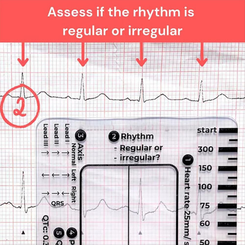 2PCS ECG 7 Step Ruler, ECG 7 Step Ruler για ερμηνεία ΗΚΓ/ΗΚΓ, 2