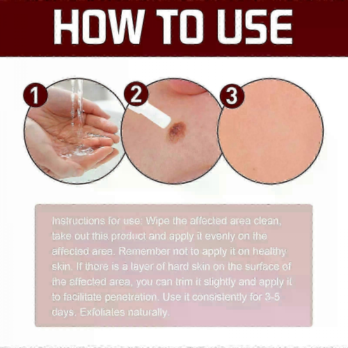 Wart removal liquid for flat skin treatment2pcs 1