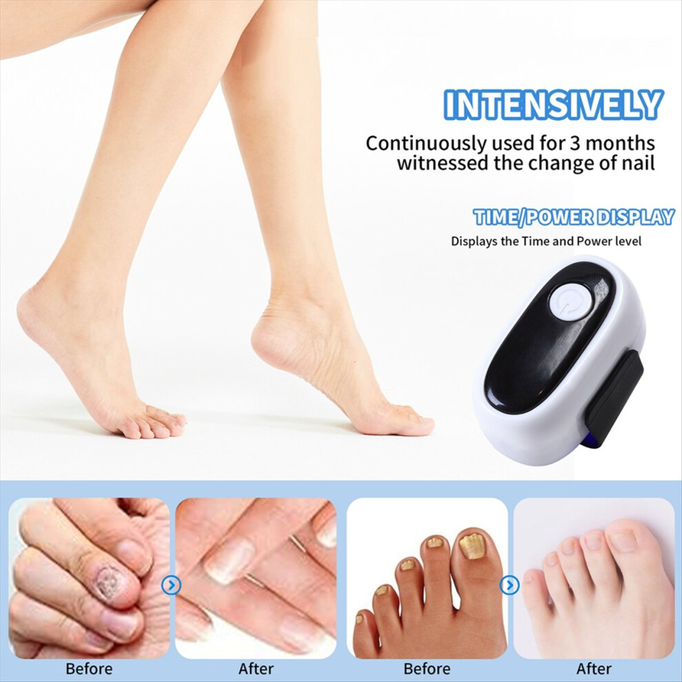 Markenlos Nail Laser Treatment Device For Treat A