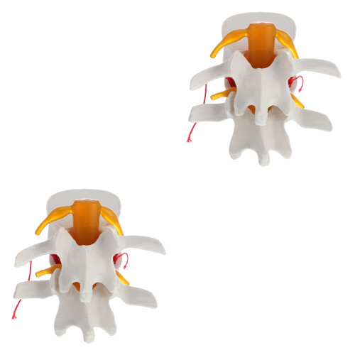 2 Pcs Human Spine Model Lumbar Disc Herniation For School 2