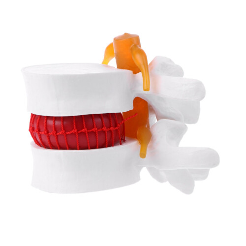 1Pc Human Spine Model Lumbar Disc Herniation For School
