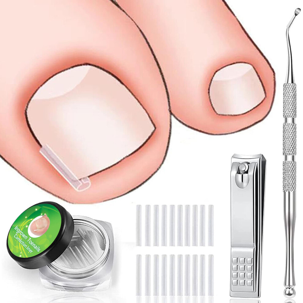 Ingrown Toenail Corrector Tool Set 60pcs, Curved Lifter & Clipper