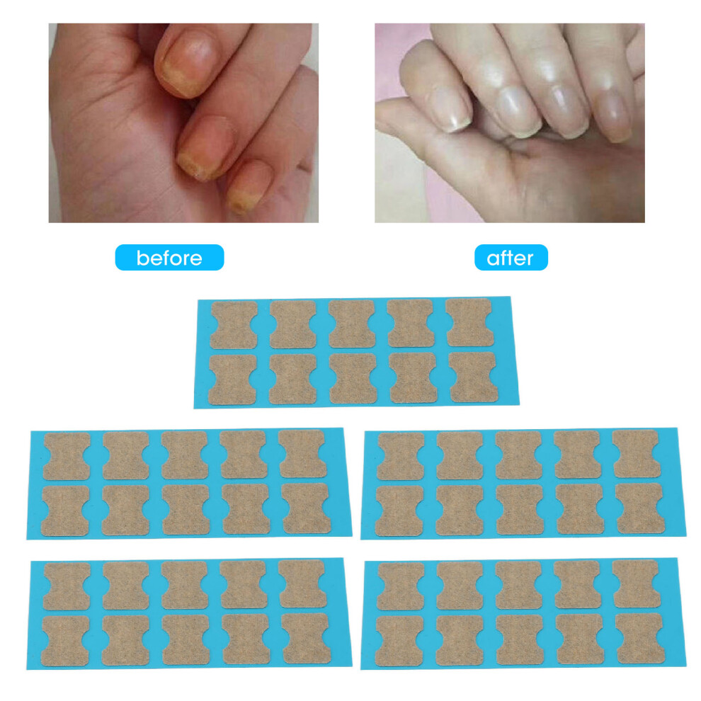 50pcs Elastic Toenail Correction Stickers Painless Ingrown Nail Patches