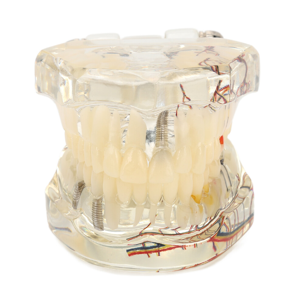 Dental Implant Pathological Model Resin for Teaching, 1/4 Veneer & Bridge